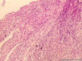 直肠组织（肠镜活检）图6