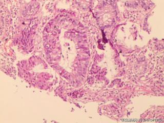 直肠活检组织图4