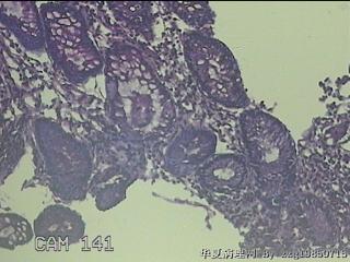 回肠末端粘膜图22