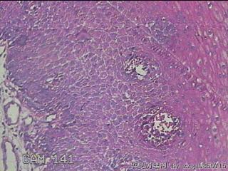 食管中段粘膜图17