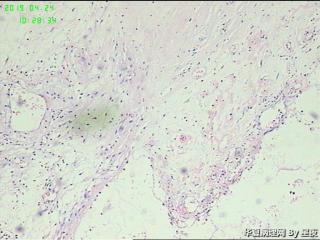 腹腔囊性肿物，请教请教？图6