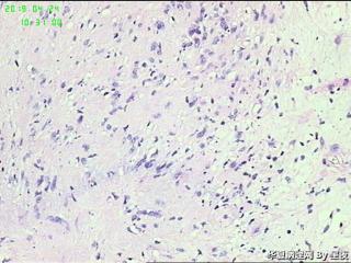 腹腔囊性肿物，请教请教？图13