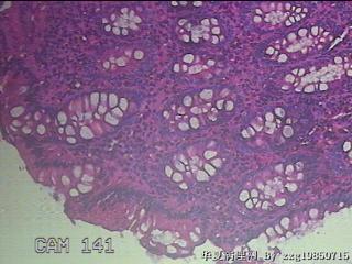 回盲部粘膜图14