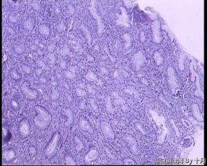 胃溃疡活检组织图14