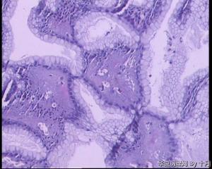 胃溃疡活检组织图19