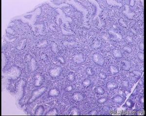 胃溃疡活检组织图13