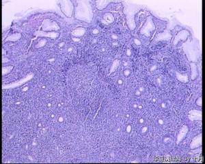 22岁，胃黏膜活检组织。图1
