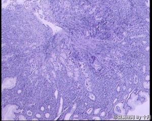22岁，胃黏膜活检组织。图14