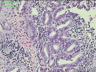 贲门活检组织，高级别？癌？图7