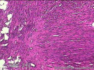 子宫肌瘤图43