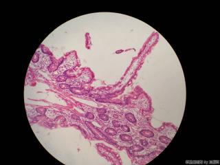 回肠末端活检图8