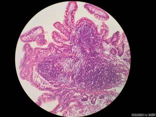 回肠末端活检图6
