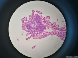 回肠末端活检图9