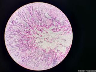 如此腔内粘液，管腔不同程度闭锁，肌层纤维化，大量炎细胞浸润，是否可以报符合慢性阑尾炎急性期图3