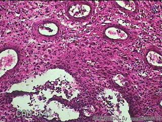 宫腔组织图40