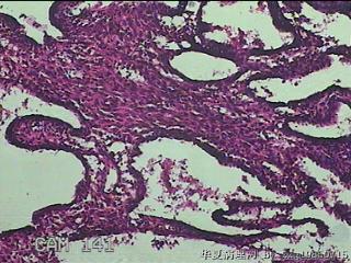 宫腔组织图34