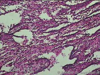 宫腔组织图50