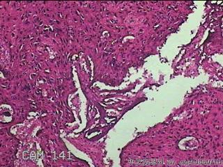 宫腔组织图48