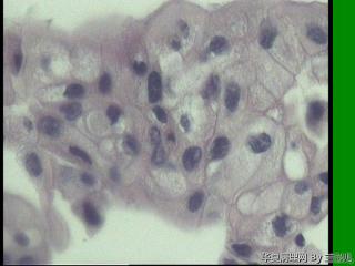 子宫内膜样腺癌，局灶伴鳞化吗？图16