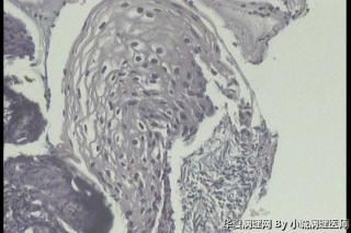 请教，这例大家都报低级别鳞状上皮内病变还是CINI伴HPV 感染图2