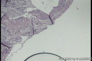 请教，这例大家都报低级别鳞状上皮内病变还是CINI伴HPV 感染图3