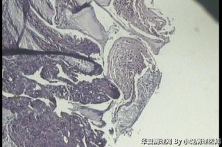 请教，这例大家都报低级别鳞状上皮内病变还是CINI伴HPV 感染图1