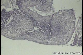 请教，这例大家都报低级别鳞状上皮内病变还是CINI伴HPV 感染图7