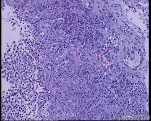 51岁，食管黏膜糜烂活检组织图32