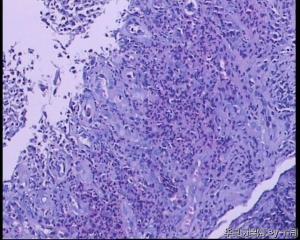 51岁，食管黏膜糜烂活检组织图27
