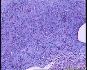 51岁，食管黏膜糜烂活检组织图4