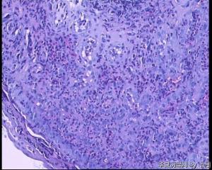 51岁，食管黏膜糜烂活检组织图3
