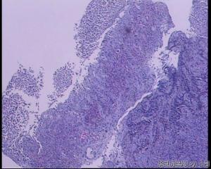 51岁，食管黏膜糜烂活检组织图24