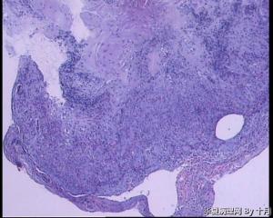 51岁，食管黏膜糜烂活检组织图1