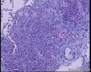 51岁，食管黏膜糜烂活检组织图25