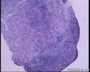 51岁，食管黏膜糜烂活检组织图10