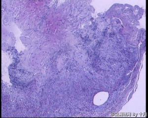 51岁，食管黏膜糜烂活检组织图2