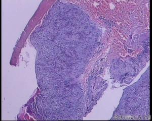 51岁，食管黏膜糜烂活检组织图33