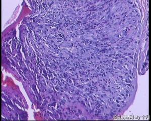 51岁，食管黏膜糜烂活检组织图35