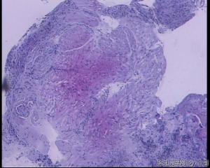 51岁，食管黏膜糜烂活检组织图6