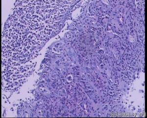 51岁，食管黏膜糜烂活检组织图28