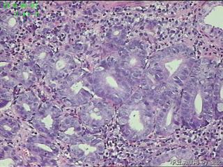 胃角活检组织，高级别？癌？图9