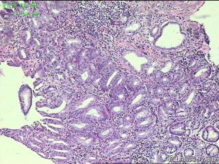 胃角活检组织，高级别？癌？图5