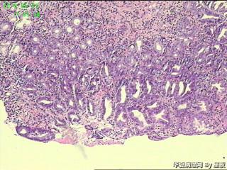 胃角活检组织，高级别？癌？图1