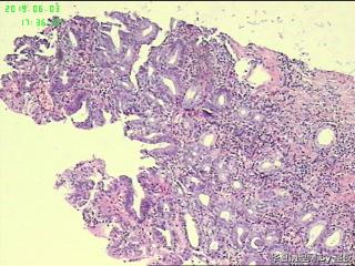 胃角活检组织，高级别？癌？图2