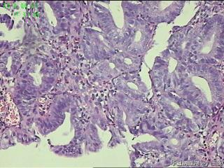 胃角活检组织，高级别？癌？图10
