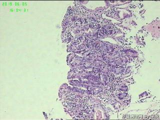 贲门活检组织，报癌没问题吧？图2