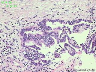 贲门活检组织，高分化腺癌？图7