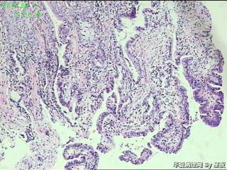 贲门活检组织，高分化腺癌？图2