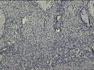 宫颈赘生物图16