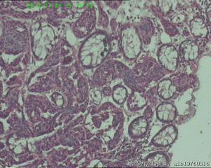 直肠息肉图4